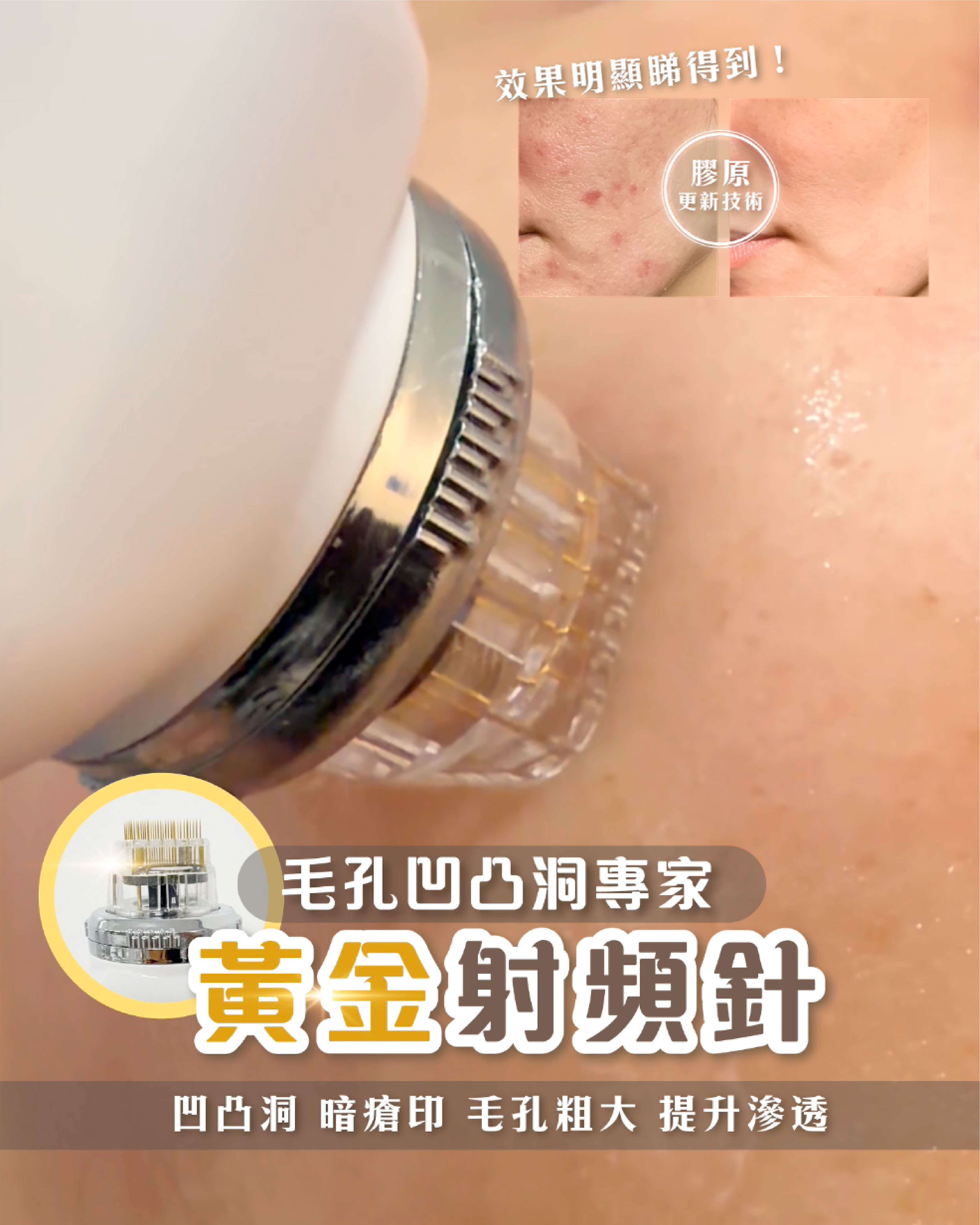 黃金射頻針皮膚再生